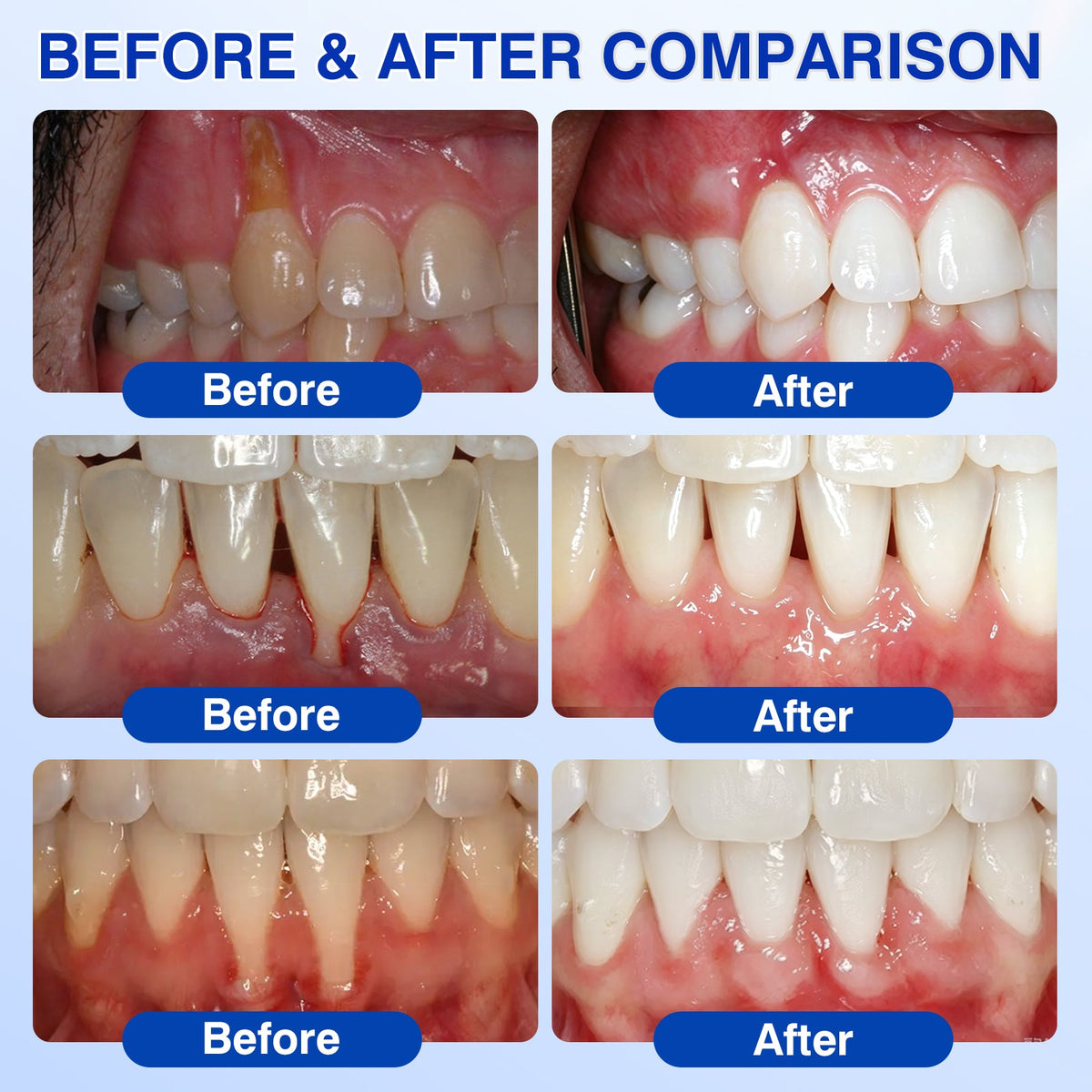 🇺🇸🏅🦷🛡️Purelora® GumRevive Periodontal Repair Gel